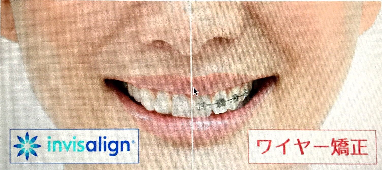 マウスピースとワイヤーの比較