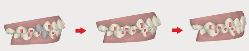 インビザラインのシミュレーション