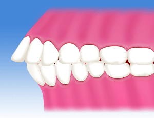 不正咬合（上顎前突・出っ歯）