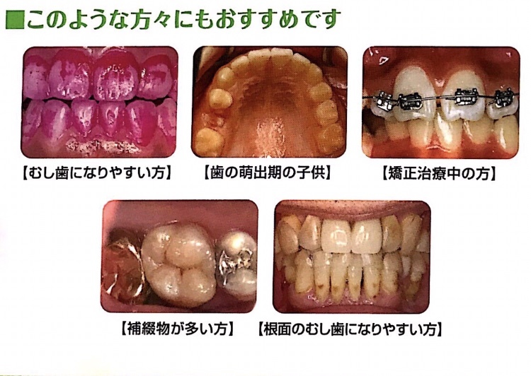 フッ素がオススメの人
