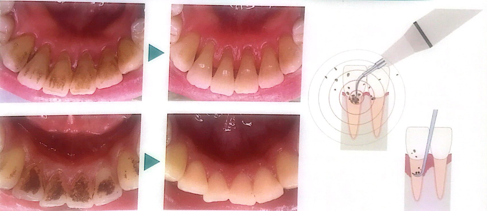 歯石、着色の除去