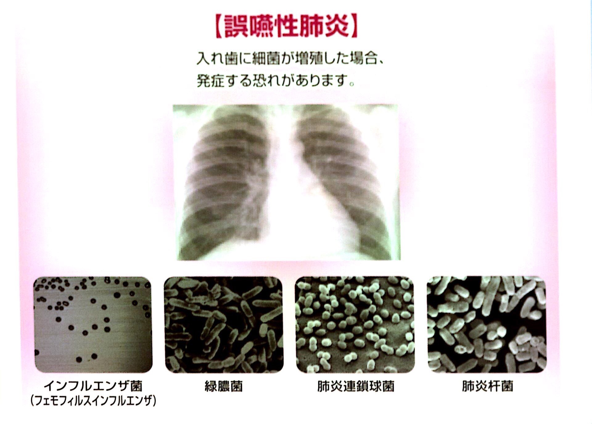 入れ歯の汚れによる体への影響