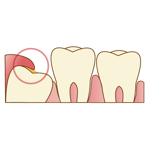 親知らずによる悪影響の一つ
