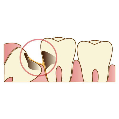 親知らずが原因で虫歯