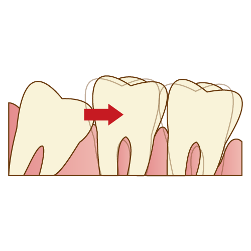 親知らずが前の歯を押す