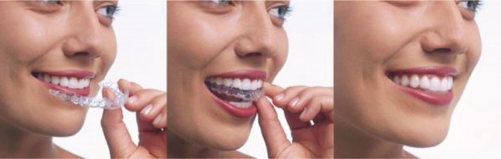 見えない矯正インビザライン