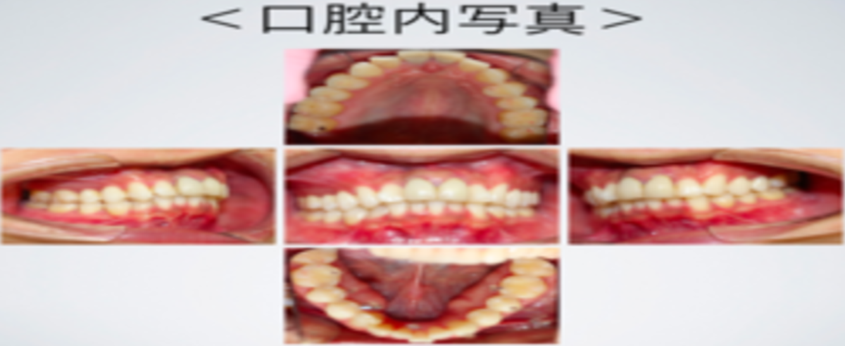 インビザライン症例写真