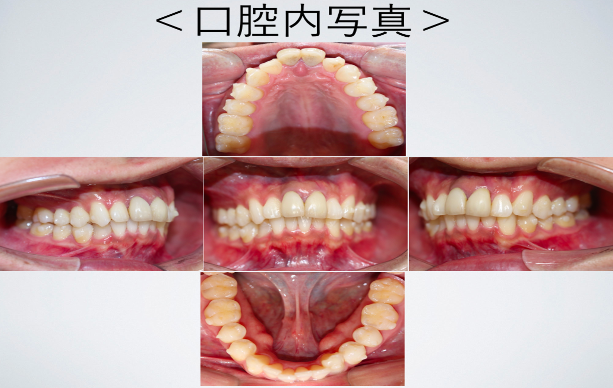 目立たない矯正インビザライン症例写真