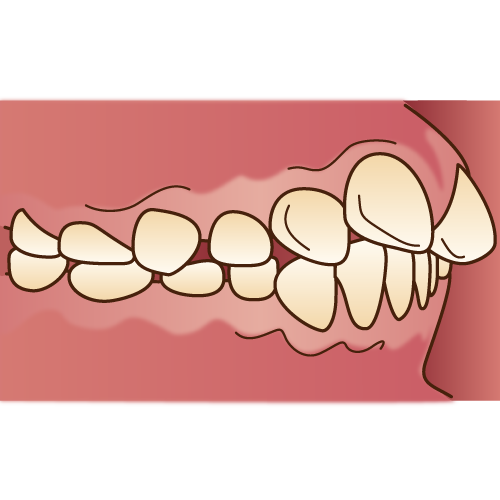 上顎前突（出っ歯）｜プレオルソ｜西国分寺ひきの歯科