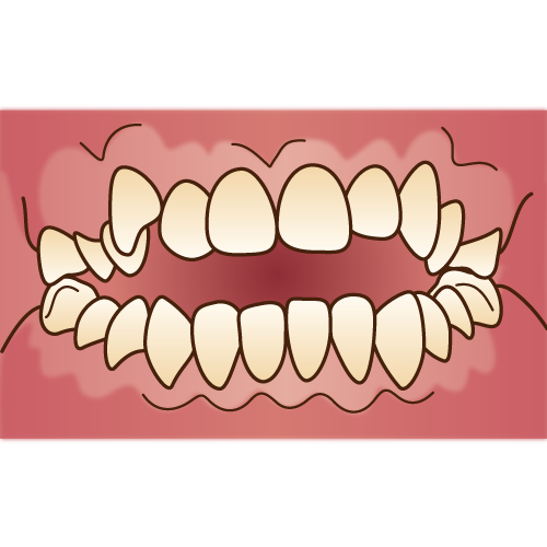 開咬（歯並び、不正咬合）プレオルソ｜西国分寺ひきの歯科