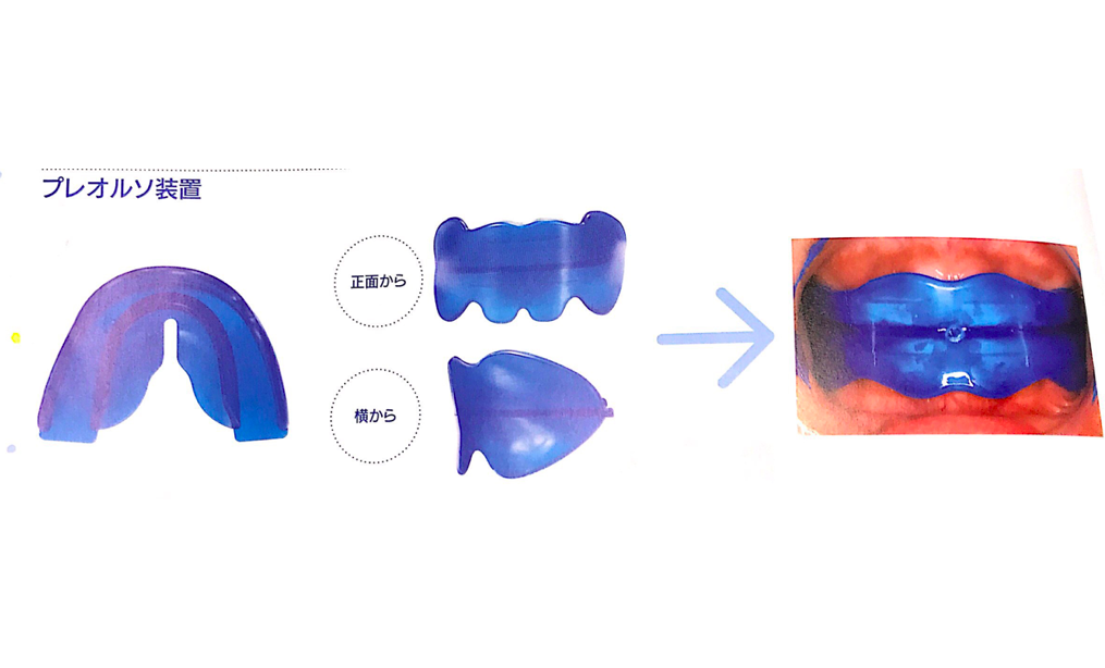 プレオルソ（マウスピース矯正）小児矯正｜西国分寺ひきの歯科