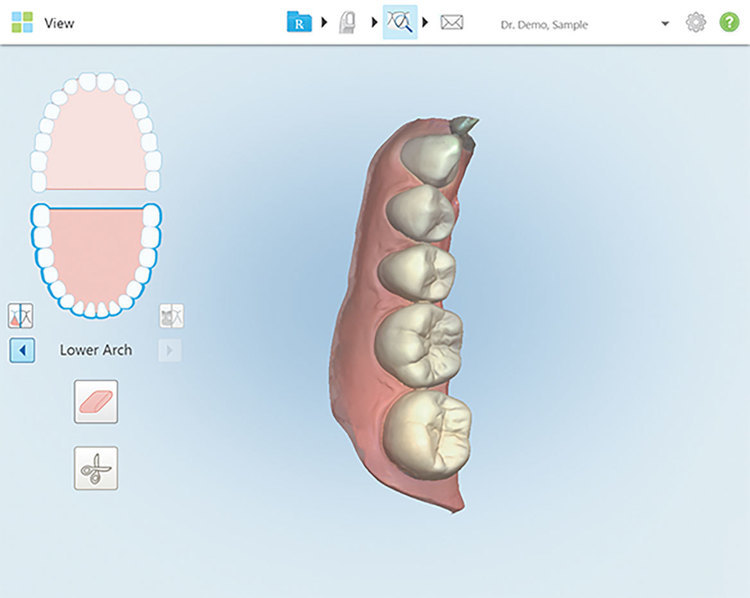 口腔内スキャンによるデータ採得