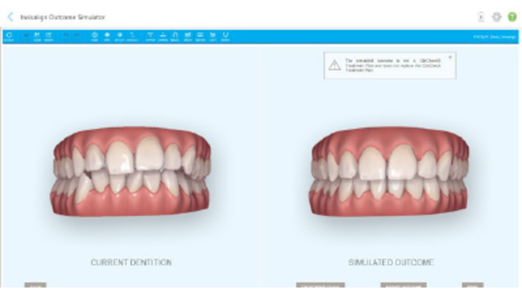 iTeroによる矯正治療のビフォーアフター