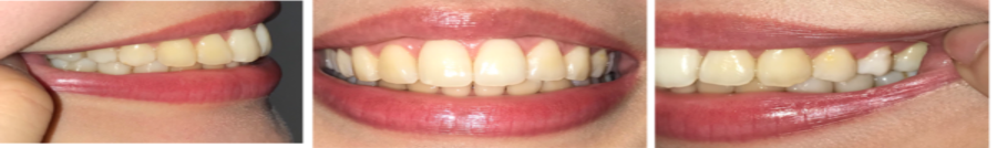 歯並びの参考写真